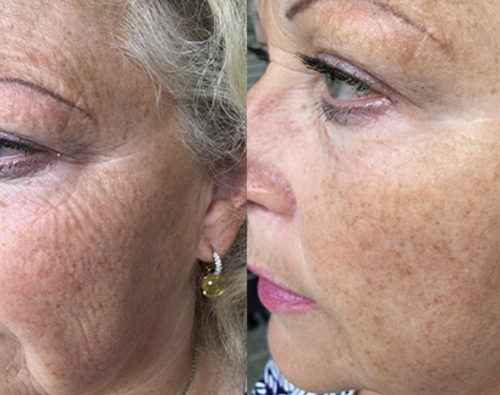 Lift Serum 2 φασεων My Image