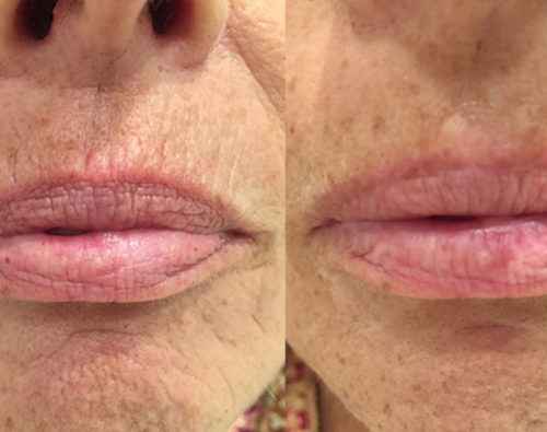 Lift Serum 2 φασεων My Image