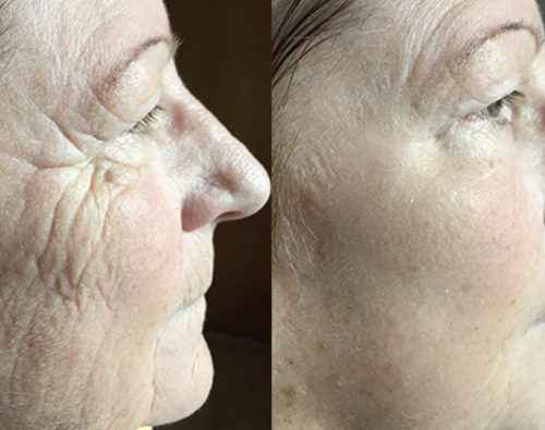 Lift Serum 2 φασεων My Image